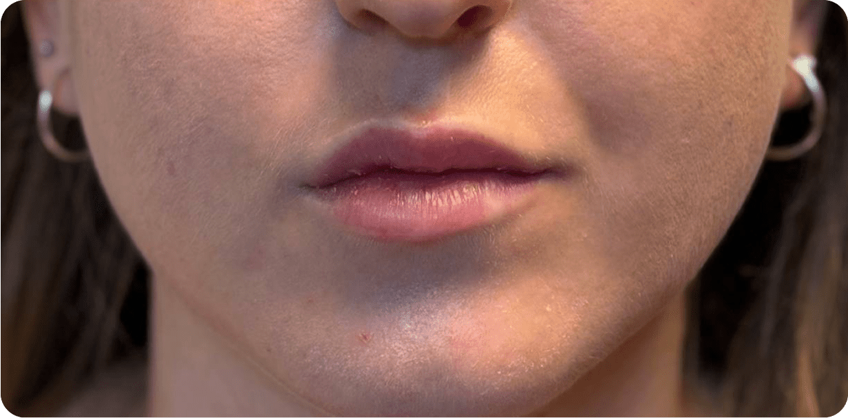 Кейс аугментації губ