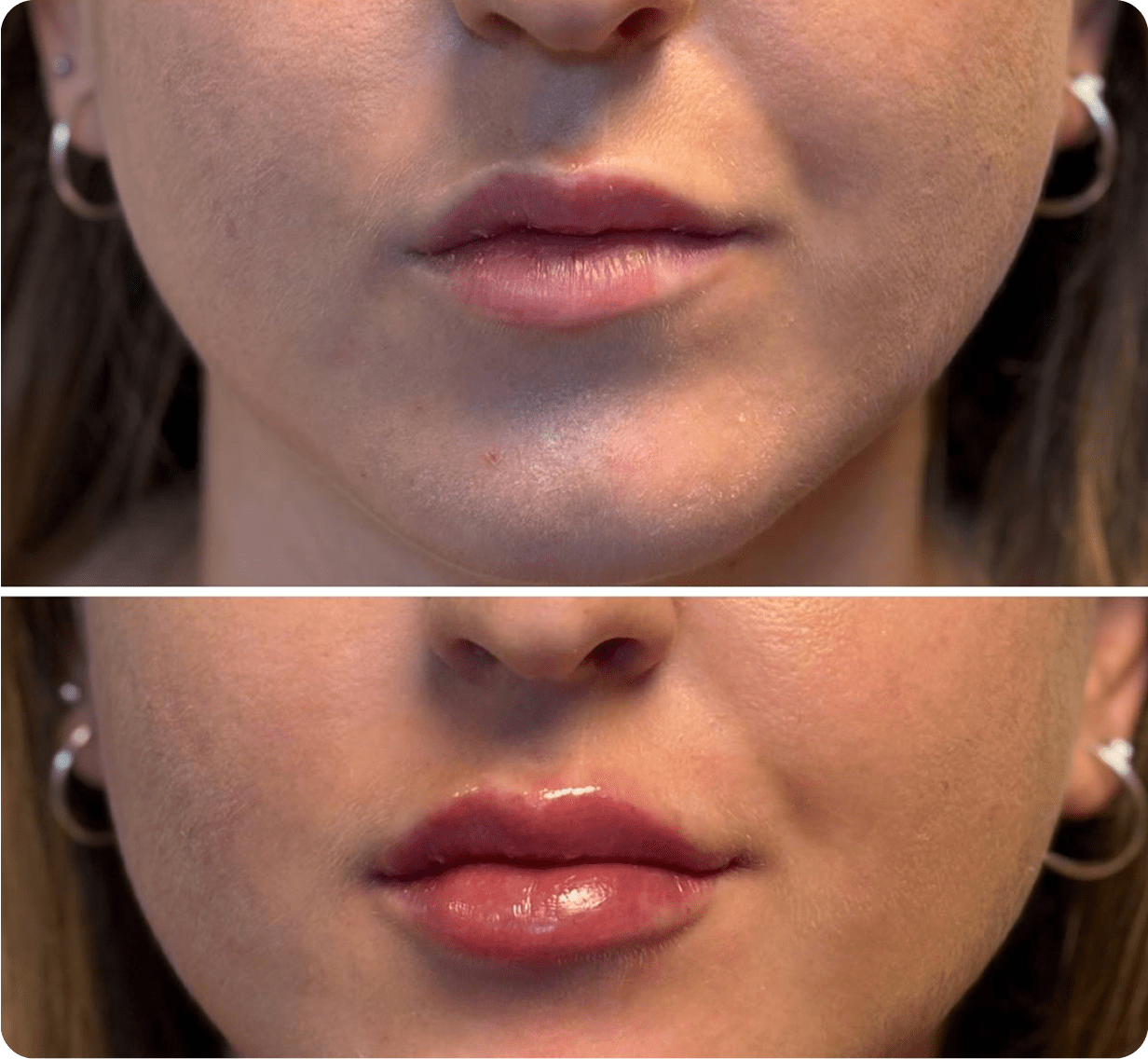 Корекція асиметрії губ