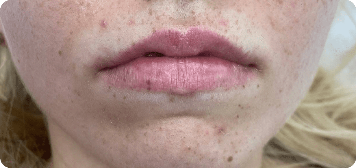 Кейс аугментації губ