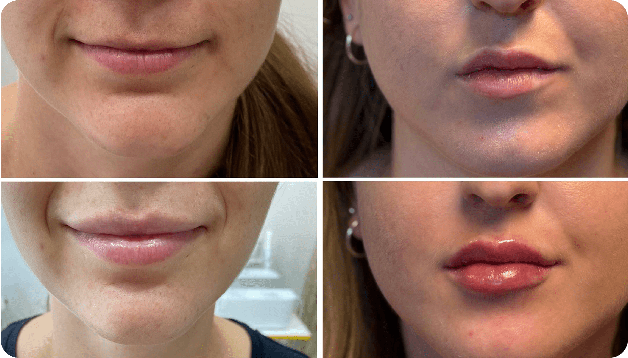 Аугментація губ