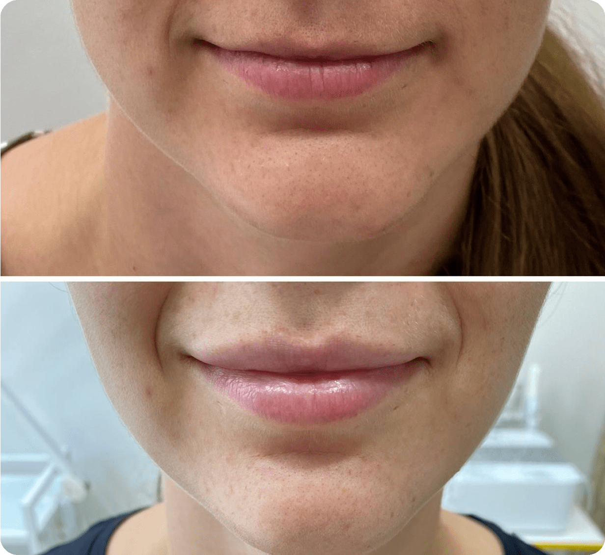 Корекція асиметрії губ