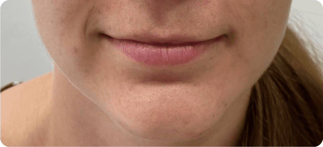 Кейс аугментації губ