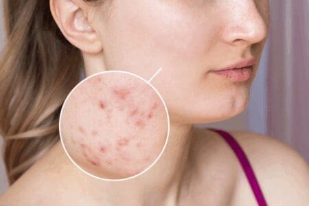 Гайдлайни лікування вугрової хвороби