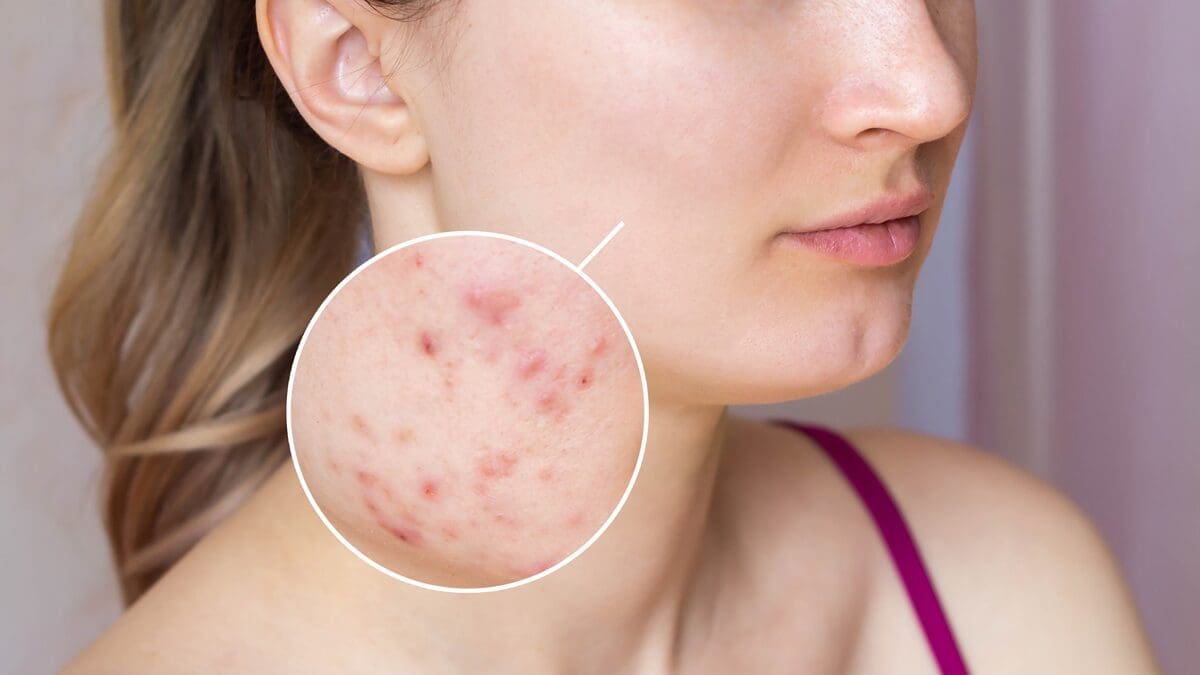 Гайдлайни лікування вугрової хвороби