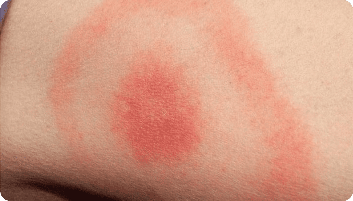 Лайм-бореліоз: діагностика та лікування