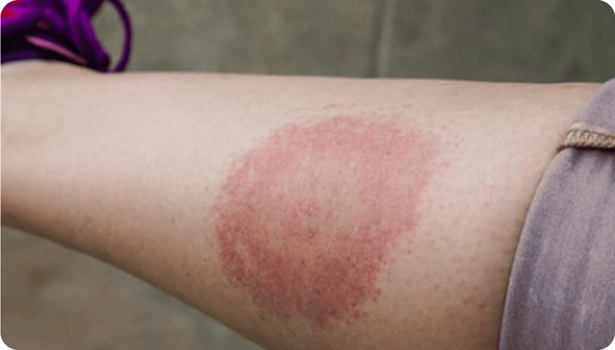 Лайм-бореліоз: діагностика та лікування