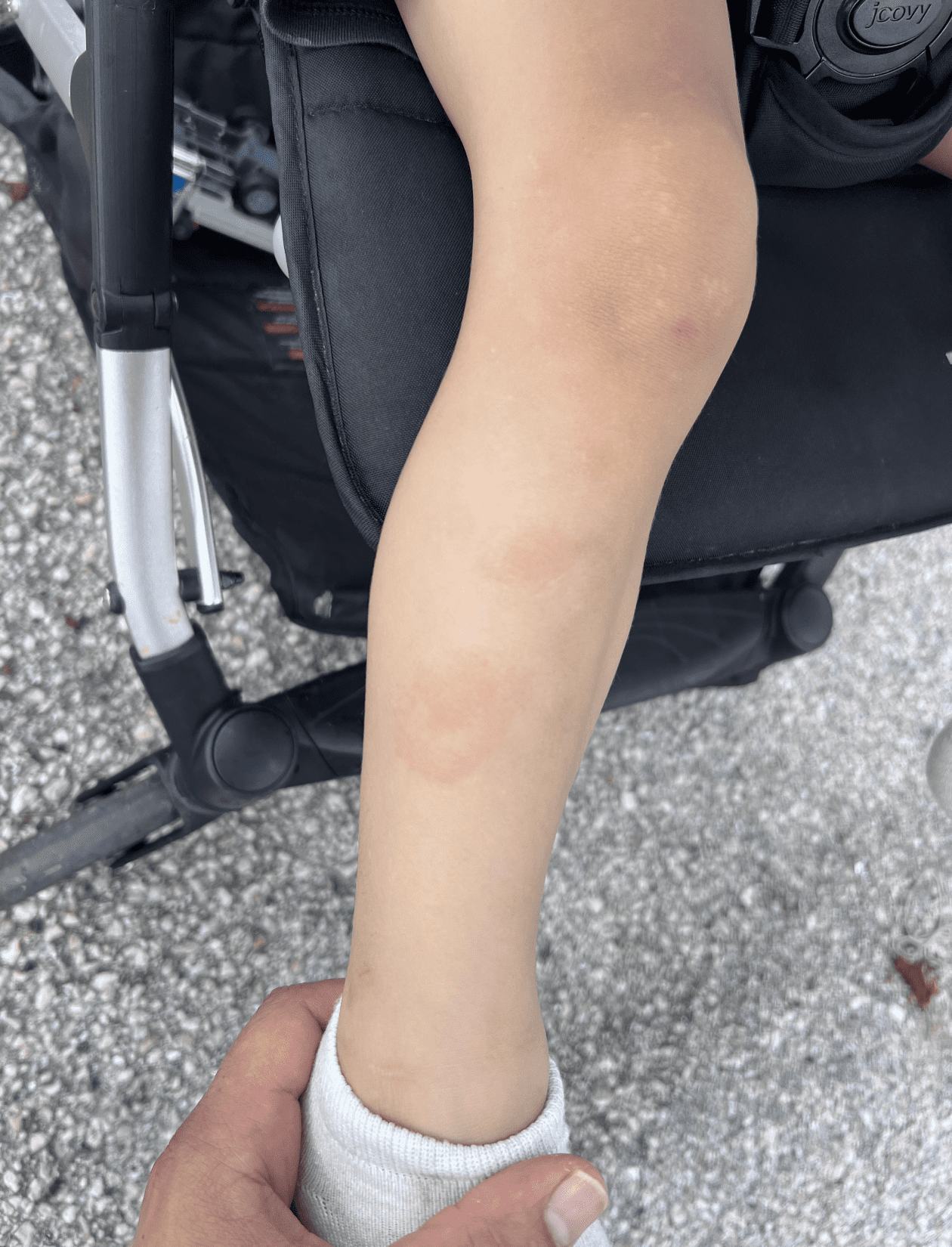 Хвороба Лайма у дітей